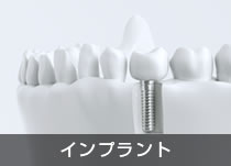 インプラント