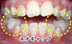 ビムラー