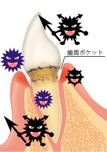 歯周病イメージ