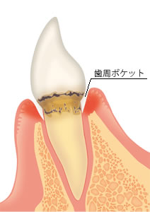 歯周ポケット